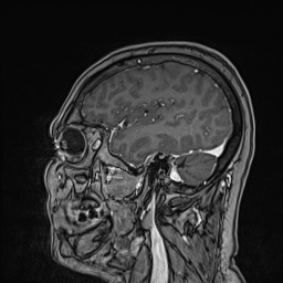 Cavernous sinus meningioma (Radiopaedia 63682-72367 Sagittal T1 C+ 53).jpg