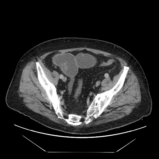 Cecal adenocarcinoma (Radiopaedia 64871-73817 A 78).jpg