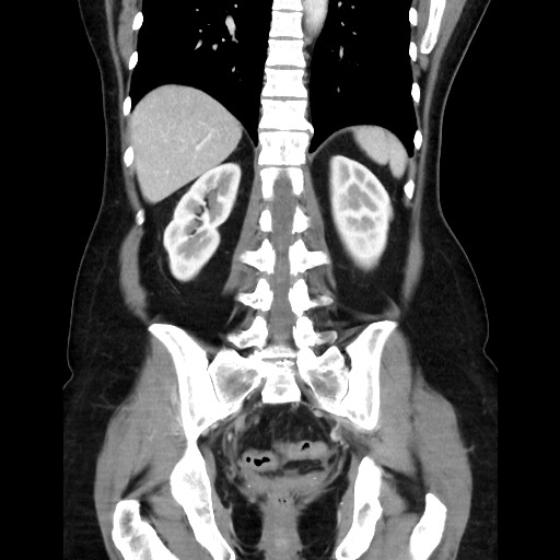 Cecal adenocarcinoma (Radiopaedia 75909-87331 B 36).jpg