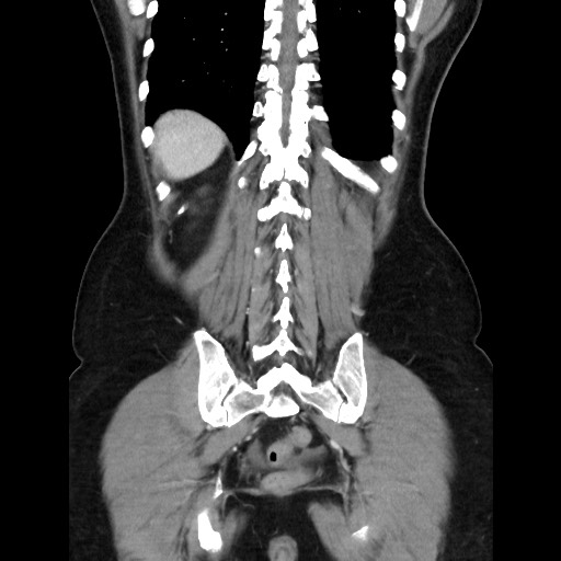 Cecal adenocarcinoma (Radiopaedia 75909-87331 B 40).jpg