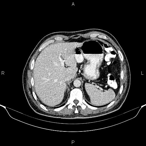 File:Cecal adenocarcinoma (Radiopaedia 85324-100916 B 18).jpg