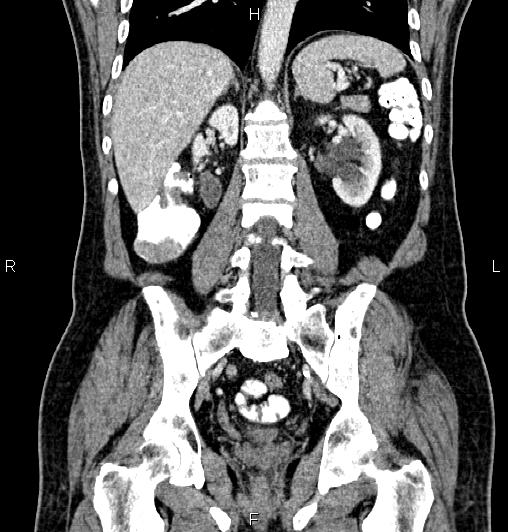 Cecal adenocarcinoma (Radiopaedia 85324-100916 D 44).jpg
