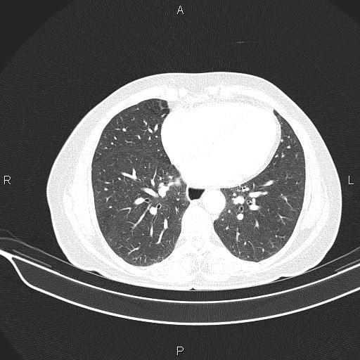 Cecal cancer (Radiopaedia 85610-101358 Axial lung window 43).jpg