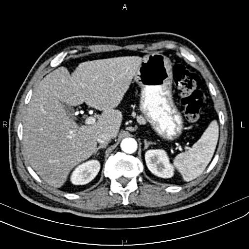 Cecal cancer with appendiceal mucocele (Radiopaedia 91080-108651 A 65).jpg