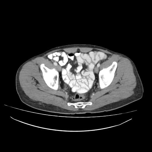 Cecal carcinoma with local lymphadenopathy (Radiopaedia 31428-32240 A 47).jpg
