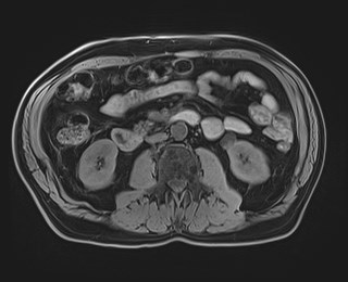 Cecal mass causing appendicitis (Radiopaedia 59207-66532 Axial T1 68).jpg