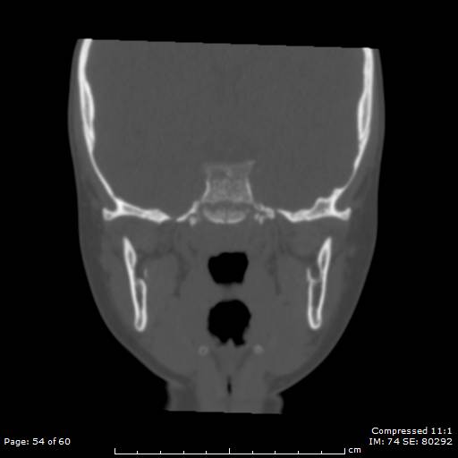 Central giant cell granuloma (Radiopaedia 45612-49754 Coronal bone window 54).jpg