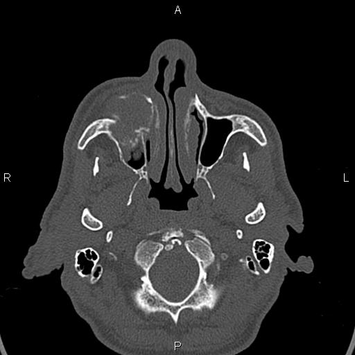 File:Central giant cell granuloma (Radiopaedia 83346-97761 Axial bone window 35).jpg