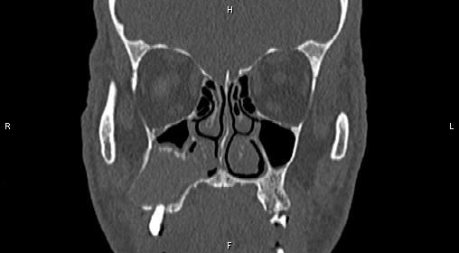 File:Central giant cell granuloma (Radiopaedia 83346-97761 Coronal bone window 13).jpg