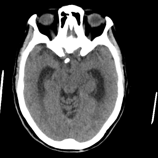 File:Central neurocytoma (Radiopaedia 65317-74346 Axial non-contrast 20).png