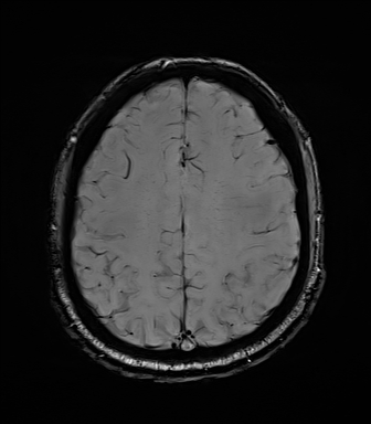 File:Central neurocytoma (Radiopaedia 71068-81303 Axial SWI 47).jpg