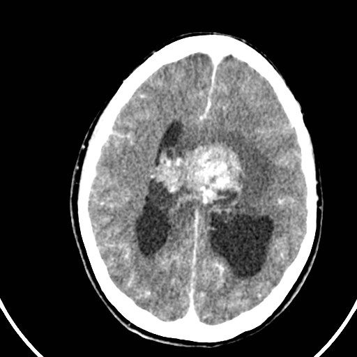 Central neurocytoma (Radiopaedia 84497-99871 B 30).jpg