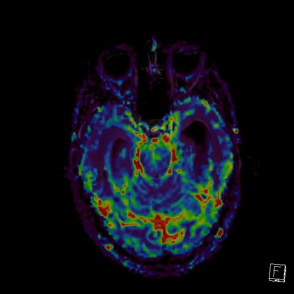Central neurocytoma (Radiopaedia 84497-99872 Axial Perfusion 214).jpg