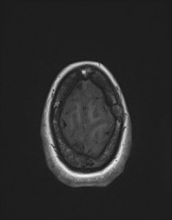 File:Central neurocytoma (Radiopaedia 84497-99872 Axial T1 170).jpg