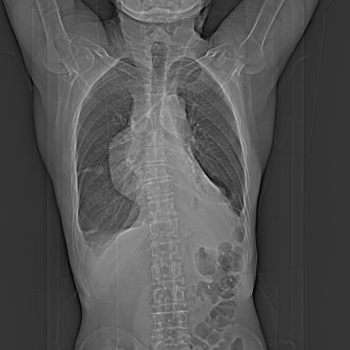 File:Central venous catheter tip extravasation (Radiopaedia 82828-97113 scout image 1).jpg