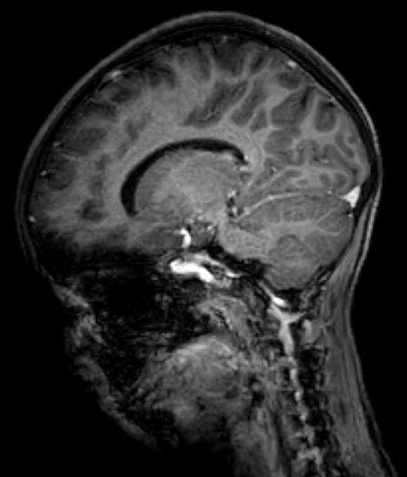 Cerebellar abscess (Radiopaedia 73727-84563 J 28).jpg