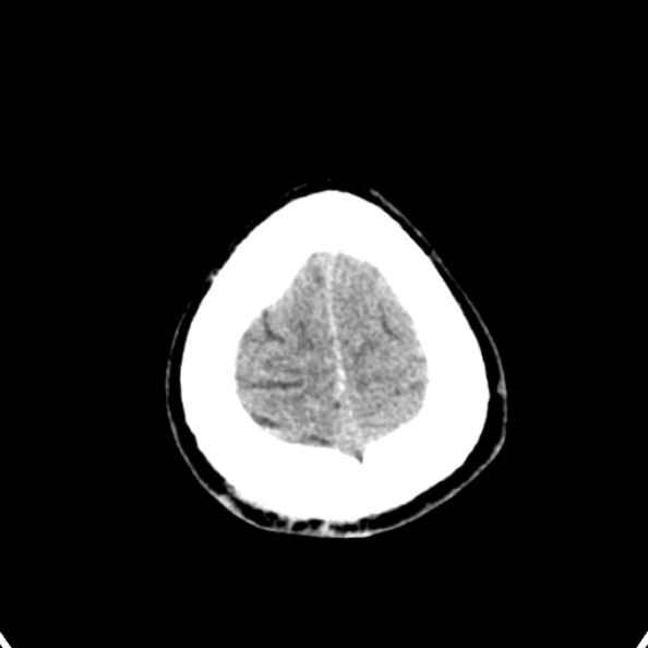 Cerebellar abscess secondary to mastoiditis (Radiopaedia 26284-26412 Axial non-contrast 145).jpg