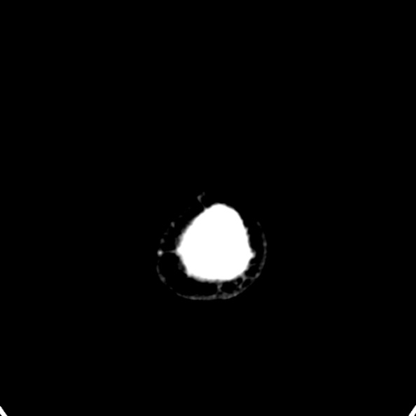 Cerebellar abscess secondary to mastoiditis (Radiopaedia 26284-26412 Axial non-contrast 159).jpg