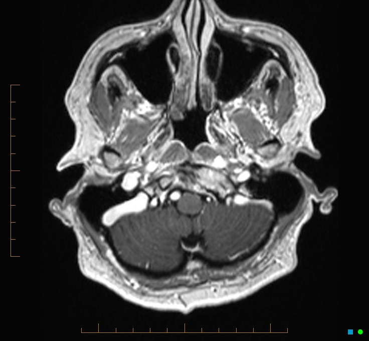 Cerebellar gangliocytoma (Radiopaedia 65377-74422 Axial T1 C+ 5).jpg