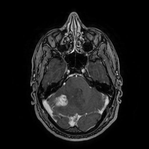 Cerebellar hemangioblastoma (Radiopaedia 88055-104622 Axial T1 C+ 62).jpg