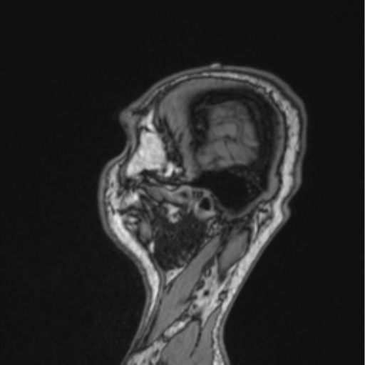 Cerebellar hemangioblastomas and pituitary adenoma (Radiopaedia 85490-101176 Sagittal T1 23).png