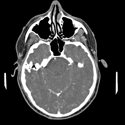 Cerebellar infarct due to vertebral artery dissection with posterior fossa decompression (Radiopaedia 82779-97029 C 3).png