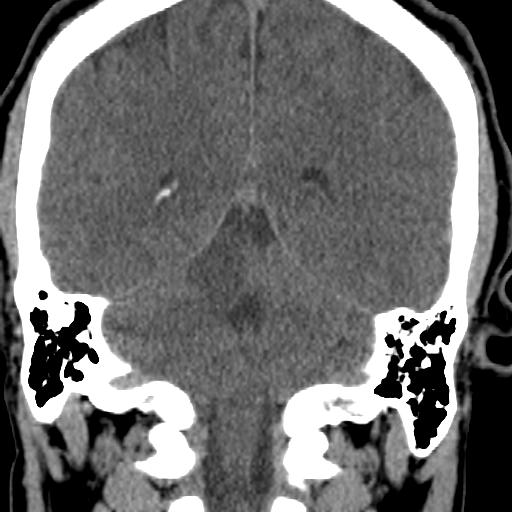 Cerebellar infarction (Radiopaedia 16625-16327 Coronal non-contrast 22).jpg