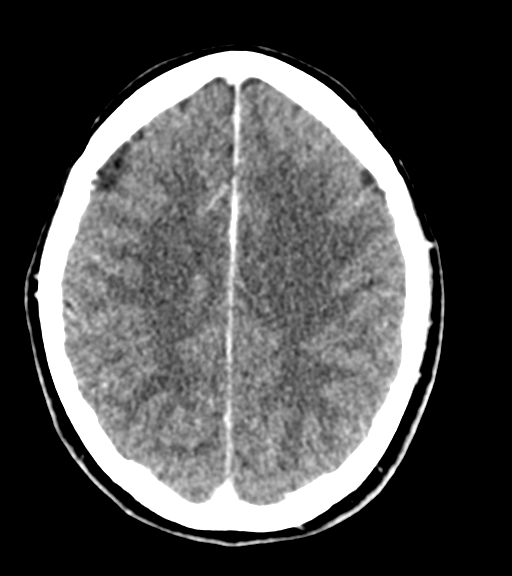 Cerebellar metastases - colorectal adenocarcinoma (Radiopaedia 40947-43652 Axial C+ 44).png