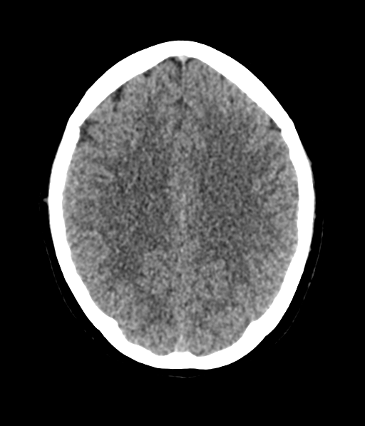 Cerebellar metastases - colorectal adenocarcinoma (Radiopaedia 40947-43652 Axial non-contrast 44).png