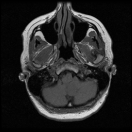 File:Cerebellar metastases - colorectal adenocarcinoma (Radiopaedia 40947-43655 Axial T1 6).png
