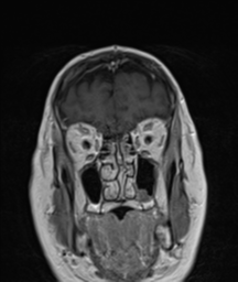 File:Cerebellar metastasis (Radiopaedia 54578-60810 Coronal T1 C+ 6).png