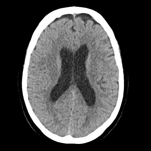 Cerebellar metastasis (Radiopaedia 54578-60812 Axial non-contrast 29).png