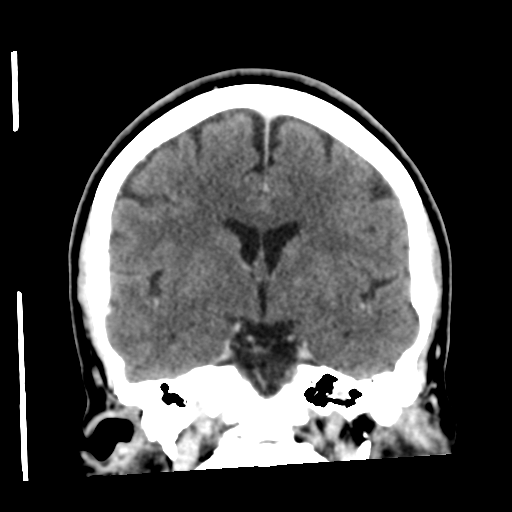 Cerebellar metastasis (cystic appearance) (Radiopaedia 41395-44258 D 31).png