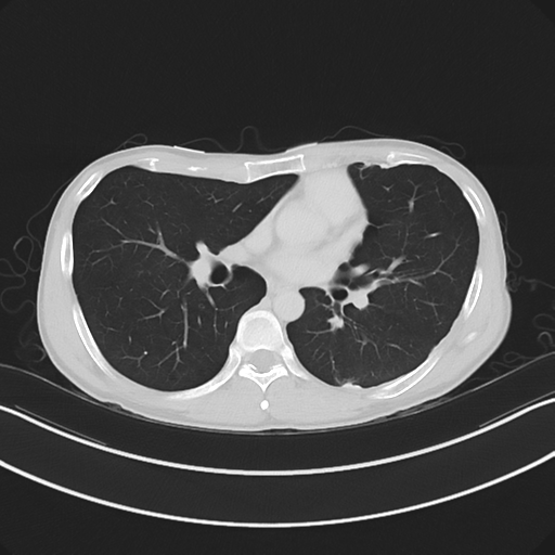 Cerebellar metastasis - adenocarcinoma lung (Radiopaedia 63184-71717 Axial lung window 36).png