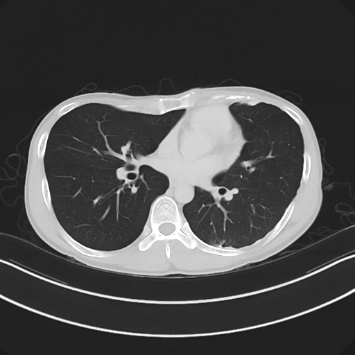 Cerebellar metastasis - adenocarcinoma lung (Radiopaedia 63184-71717 Axial lung window 39).png