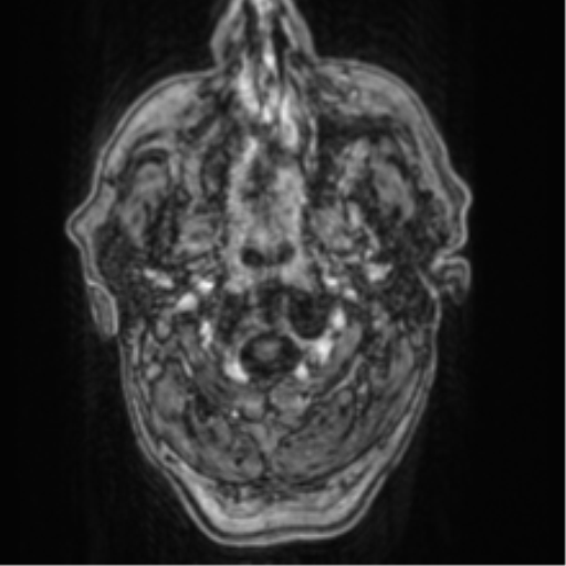 Cerebellar metastasis from lung adenocarcinoma (Radiopaedia 86690-102829 Axial T1 C+ 1).png