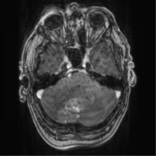 Cerebellar metastasis from lung adenocarcinoma (Radiopaedia 86690-102829 Axial T1 C+ 22).png