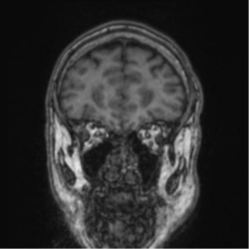 Cerebellar metastasis from lung adenocarcinoma (Radiopaedia 86690-102829 Coronal T1 78).png