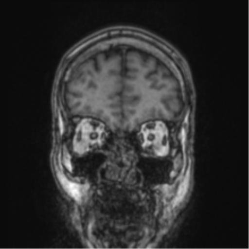 Cerebellar metastasis from lung adenocarcinoma (Radiopaedia 86690-102829 Coronal T1 82).png