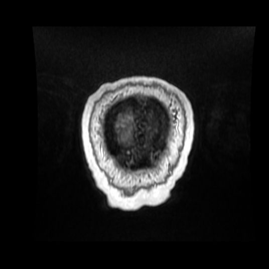 Cerebellar metastasis of pulmonary adenocarcinoma, cavernous venous malformation, and developmental venous anomaly (Radiopaedia 85827-101661 Coronal T1 C+ 11).jpg