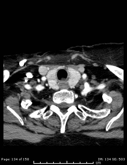 File:Cerebellar strokes due to intracranial giant cell arteritis (Radiopaedia 68799-78510 CT angiogram 134).jpg