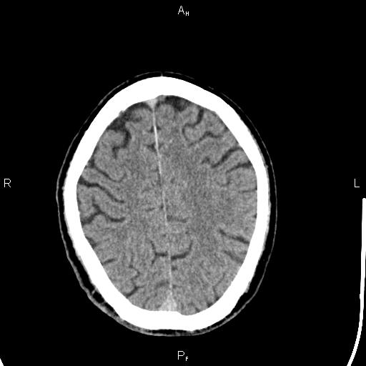 Cerebellopontine angle arachnoid cyst (Radiopaedia 85149-100704 Axial With contrast 39).jpg