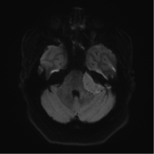 Cerebellopontine angle meningioma (Radiopaedia 48434-53348 Axial DWI 46).png