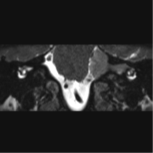 Cerebellopontine angle meningioma (Radiopaedia 48434-53348 Coronal T2 51).png
