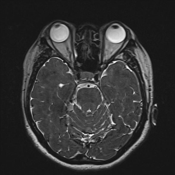 Cerebellopontine angle meningioma (Radiopaedia 53561-59591 Axial 3D volume T2 84).jpg