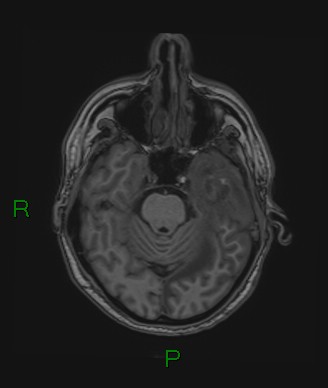 Cerebral abscess and subdural empyema (Radiopaedia 84436-99779 Axial T1 59).jpg