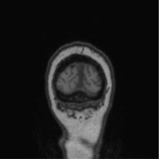 Cerebral abscess from pulmonary arteriovenous malformation (Radiopaedia 86275-102291 Coronal T1 9).png