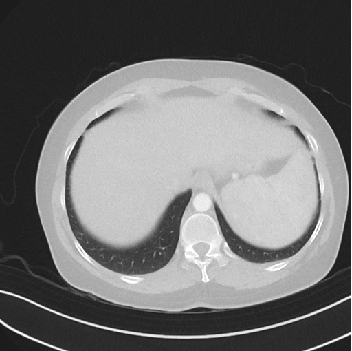 File:Cerebral abscess from pulmonary arteriovenous malformation (Radiopaedia 86275-102292 Axial lung window 50).png