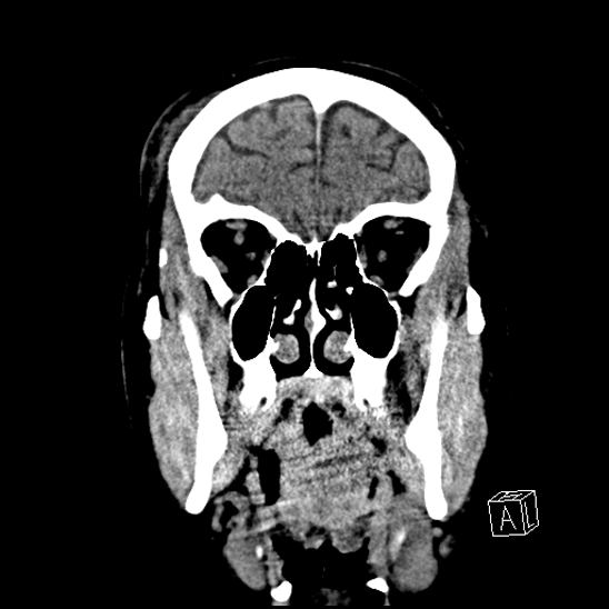 File:Cerebral abscess with ventriculitis (Radiopaedia 78965-91876 B 12).jpg