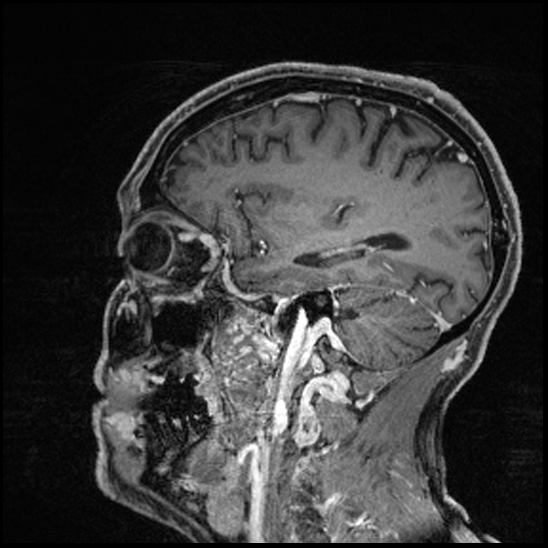 Cerebral abscess with ventriculitis (Radiopaedia 78965-91878 Sagittal T1 C+ 127).jpg